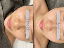 クレドペール(Eclat de Perles)/毛穴、くすみ、ニキビでお悩み。