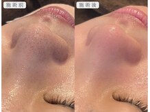 メンズ眉毛サロンUnknown. 中津店【メンズ眉毛/アイブロウ/眉毛パーマ/メンズネイル】/毛穴洗浄