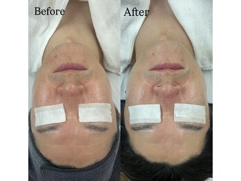 フロムミー 銀座本店(FROM ME)/3Xダーマジオ/シミ/小顔/銀座