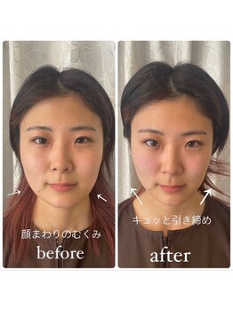 鍼グリッター 岡山本院(鍼Glitter.)/【ビフォーアフター】美容鍼