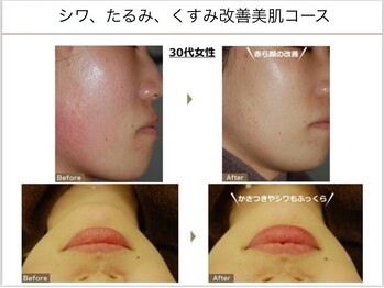 ベッラドンナ(Bella donna)/赤ら顔 BeforeAfter