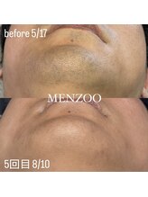 メンズー(MENZOO)/