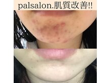 パルサロン(palsalon.)の雰囲気（お肌悩みは皮が剥けないハーブピーリング！）