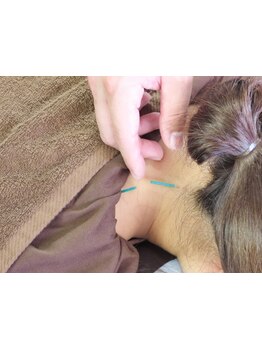 鍼灸施術を受けたい