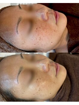 ソア/【掛け合わせケア】　3回