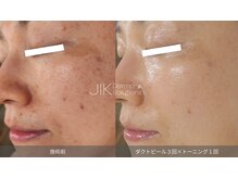 アティロン(Attirant)/【シミ改善ダクトピール】