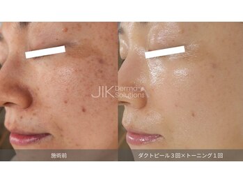 アティロン(Attirant)/【シミ改善ダクトピール】