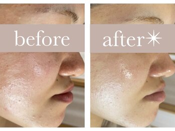 エバーグリーン(Evergreen)/ハーブピーリング1回の変化