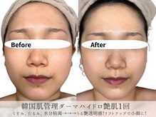 ミヨンラボ(miyon LABO)/韓国肌管理ダーマハイドロ1回