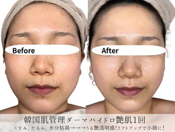 ミヨンラボ(miyon LABO)/韓国肌管理ダーマハイドロ1回