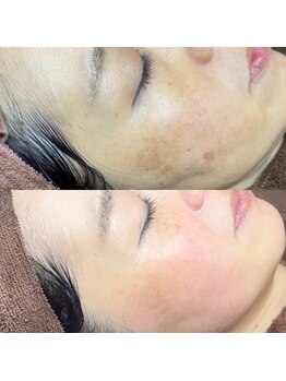 ホワラ 横浜店(Whila)/施術効果１3