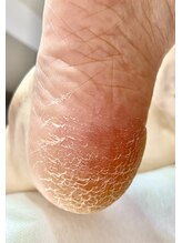 ラヴィ(La vie)/ヒビ割れかかと…