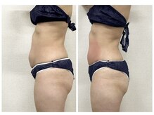 ミロク(369)/Before&After 脂肪冷却痩身