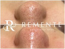 モテ 新宿店(Mote)/ハイドラ毛穴洗浄＋艶肌Wax 新宿