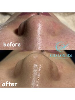 シャロンドットエイチエム(CHALON.HM)/韓国式毛穴洗浄