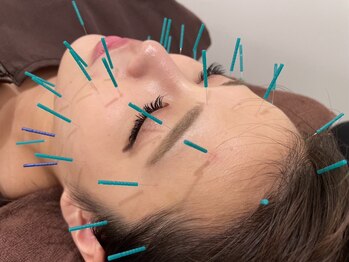 トゥービー(TWO-B)/【美容鍼】美しいお顔に☆