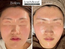ヒジ(Life Salon)の雰囲気（レモンボトル導入！フェイスライン/小顔ケア◎Before /After）