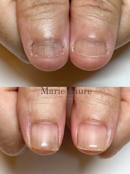 マリーロール 梅田店(Marie Laure)/自爪育成/深爪矯正/ネイルケア