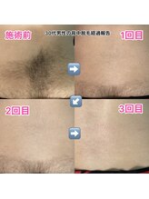 ブロッサム(BLOSSOM)/男性腰脱毛