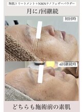 クレヴィー(Creviy)/陶肌トリートメント＋NMN