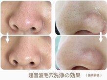 フェイシャルエステ エムズルーム(M's room)/他とは違う毛穴洗浄★黒ずみ撃退