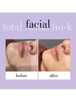 ヌック(NO-K)/光フェイシャル
