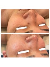 ラディエンス 多治見店/メンズ毛穴エステ