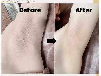 グロウ(Grow)/【店長イチ押し】全身脱毛