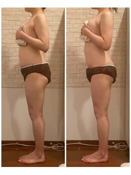 うつくし痩身 美サロン ゼットワン(Z-ONE)/ボディ　ビフォーアフター