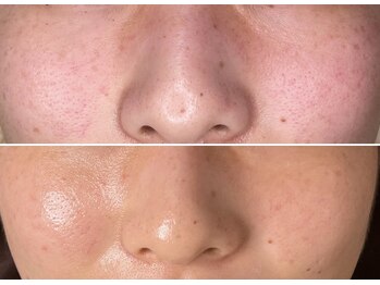 エイプリルフールズ(April fools)/お肌の赤みが消え安定しました！