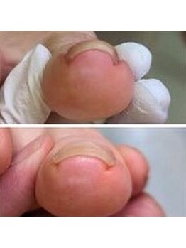 ヴァンネイルサロンアンドフットリラクゼーション(Van Nail Salon & Foot relaxation)の写真/【巻き爪ケア】専門知識を持ったスタッフが対応♪セルフケアアドバイス付で繰り返す悩みから卒業!!本厚木