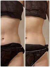 サロン アンネ(Anne)/ウィンバックお腹