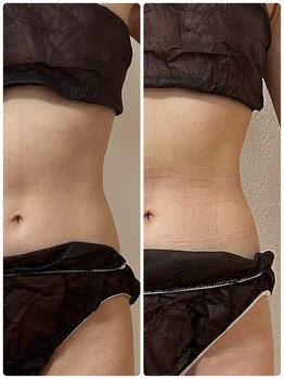 サロン アンネ(Anne)/ウィンバックお腹