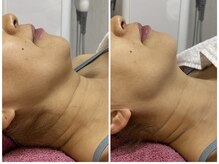 GRACETHOUSAND(グレイスサウザンド)/首のシワに/ハーブピーリング