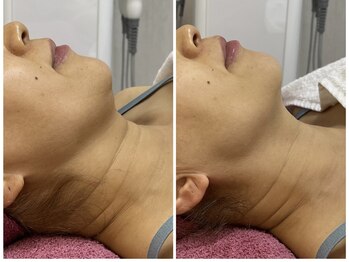 GRACETHOUSAND(グレイスサウザンド)/首のシワに/ハーブピーリング