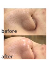 ミノア 熊本店(MINOA)/毛穴洗浄/毛穴/赤み