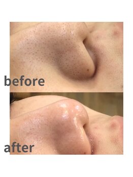 ミノア 熊本店(MINOA)/毛穴洗浄/毛穴/赤み