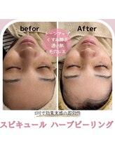 マヴィ 香里園店(MavY.)/ハーブピーリング