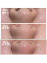 ヌル(null.)/毛穴エクストラクション