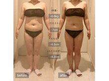 シエル(ciel)の雰囲気(固まったセル脂肪を高周波で燃焼(集中コース8回before→after))