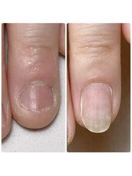 スマイルニコ(smile nico)/爪のピンクの部分は伸びる