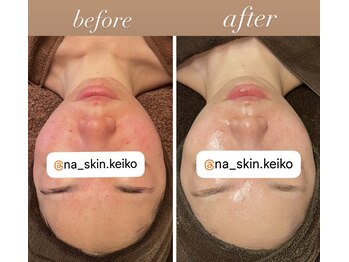 雅菜(miyabina)/長年のお悩み10か月で肌質改善！