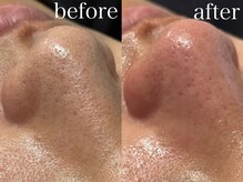 ルテア(Retea.)/ハイドロ毛穴洗浄