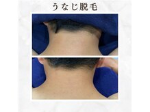 ボゴス 天白店(BOGOSS)/【うなじ脱毛】施術写真