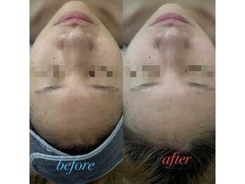 ファーファラ(Farfalla)/ハーブピーリング