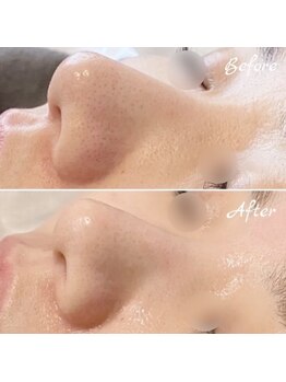 ラルミエール 緑店はなれ(la lumiere)/毛穴コース