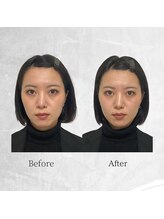 ビスイ 恵比寿(Bisui)/《恵比寿》小顔矯正1回目