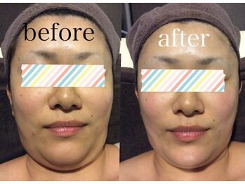 トータルビューティージュネス(TOTAL BEAUTY JEUNESSE)/サーモシェイプ フェイス