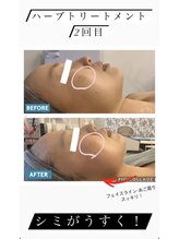 マリス(MARISS)/ハーブトリートメント【毛穴】