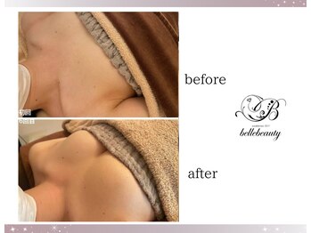 ベルビューティー(belle beauty)/バストアップ◇症例◇